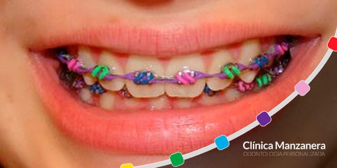 brackets de colores