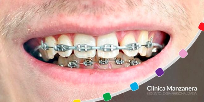 Brackets de Colores: Todos los tipos de brackets de Colores