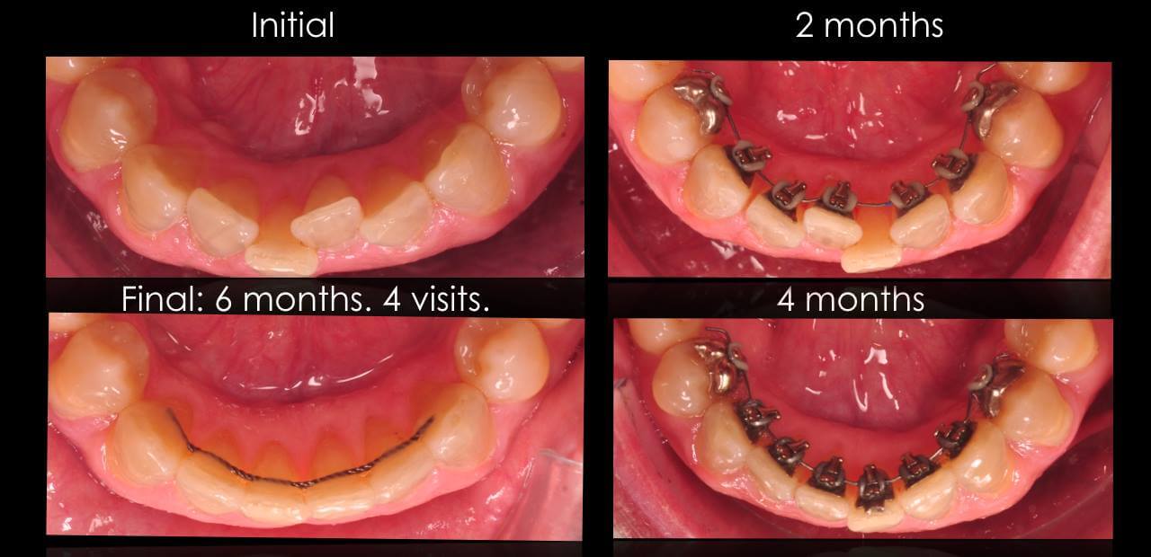 ortodoncia lingual en solo seis meses
