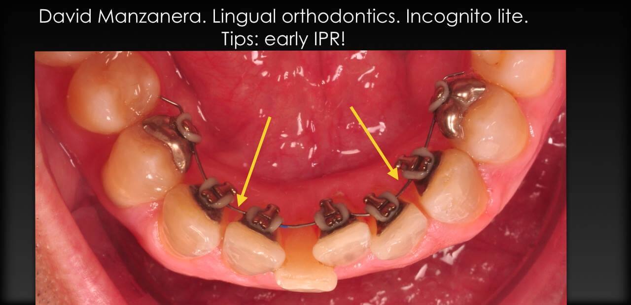 ortodoncia incógnito en apinamiento inferior