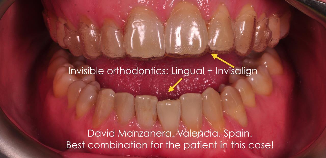 ortodoncia lingual combinada con invisalign