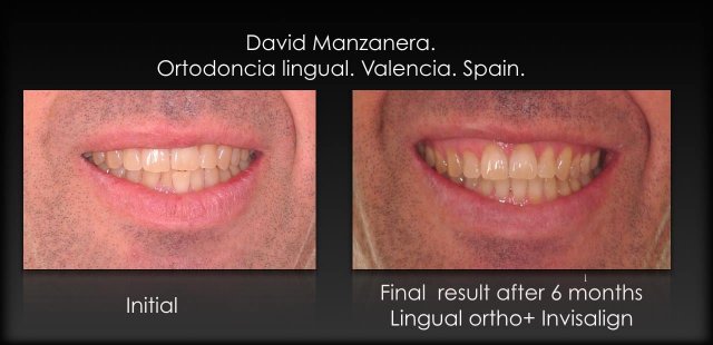 combinación de ortodoncia lingual invisible abajo, y alineadores transparentes Invisalign arriba