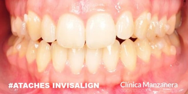 ataches invisalign