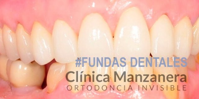 fundas dentales valencia precio