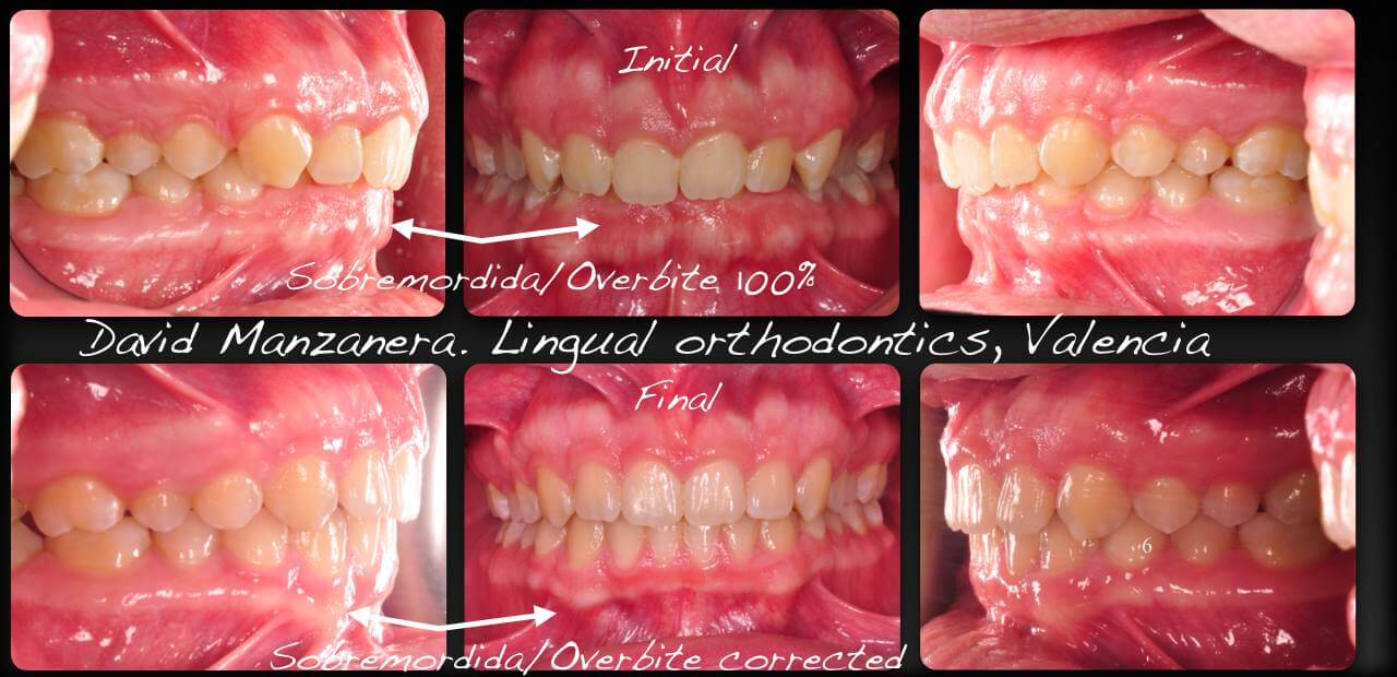 antes y despues tratamiento ortodoncia lingual