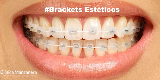 brackets esteticos