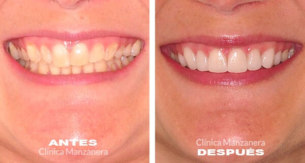 Carillas dentales para la estética dental