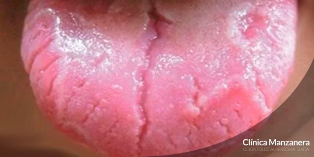 grietas en la lengua