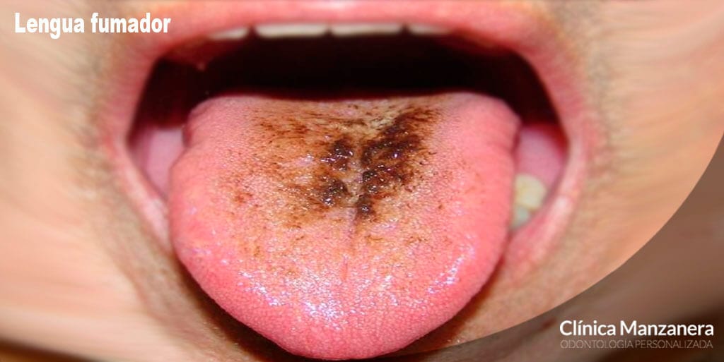 lengua color marron cafe de un fumador