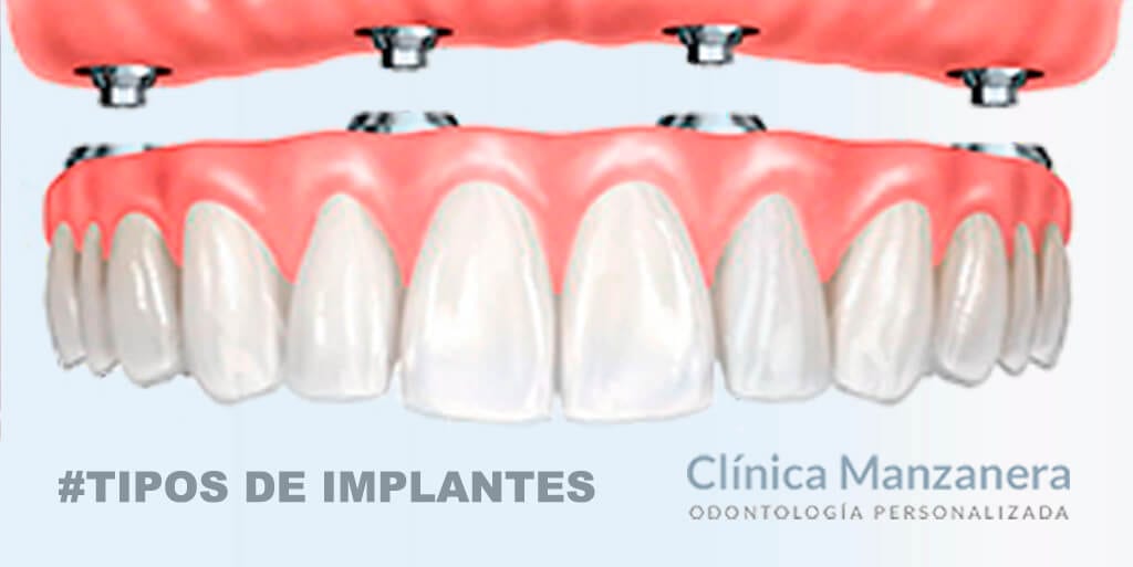 tipos implantes dentales