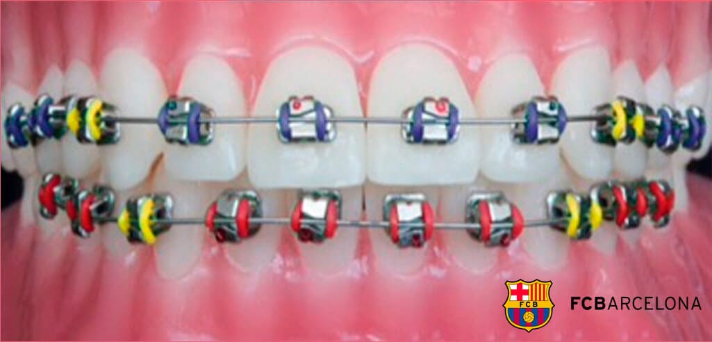 sesión Glorioso Mansedumbre Brackets de Colores: Todos los tipos de brackets de Colores