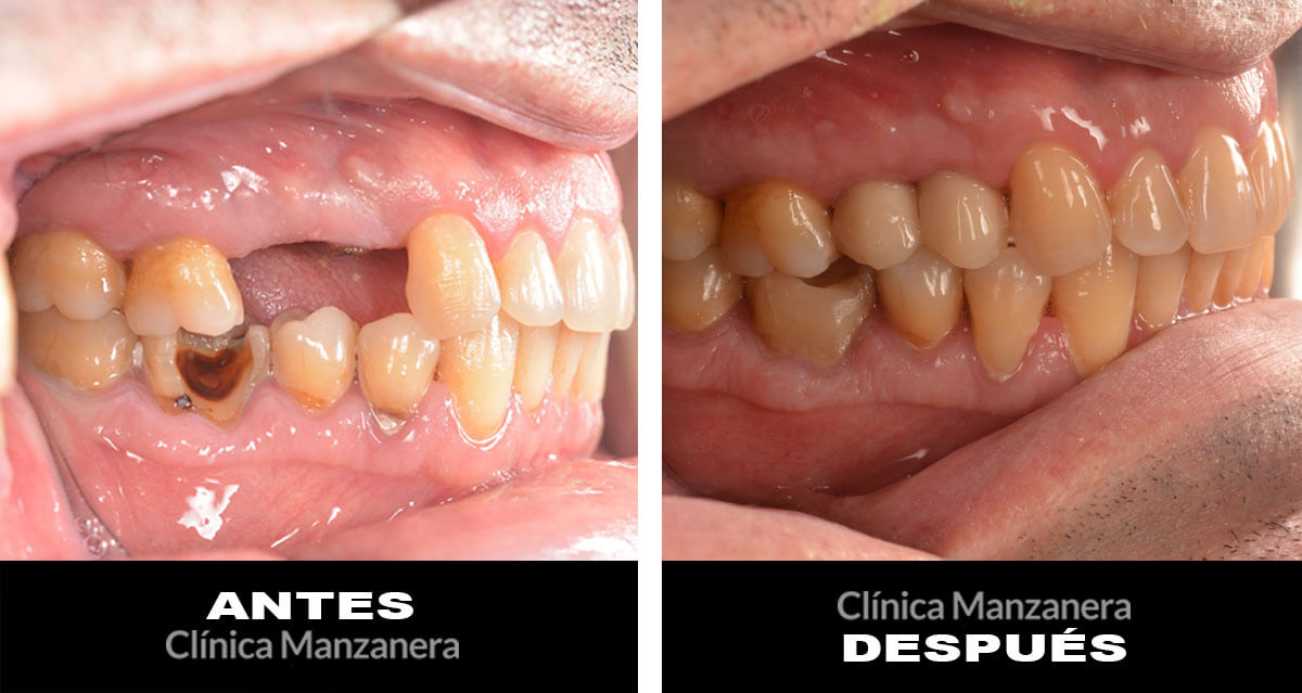 Antes y después implantes dentales