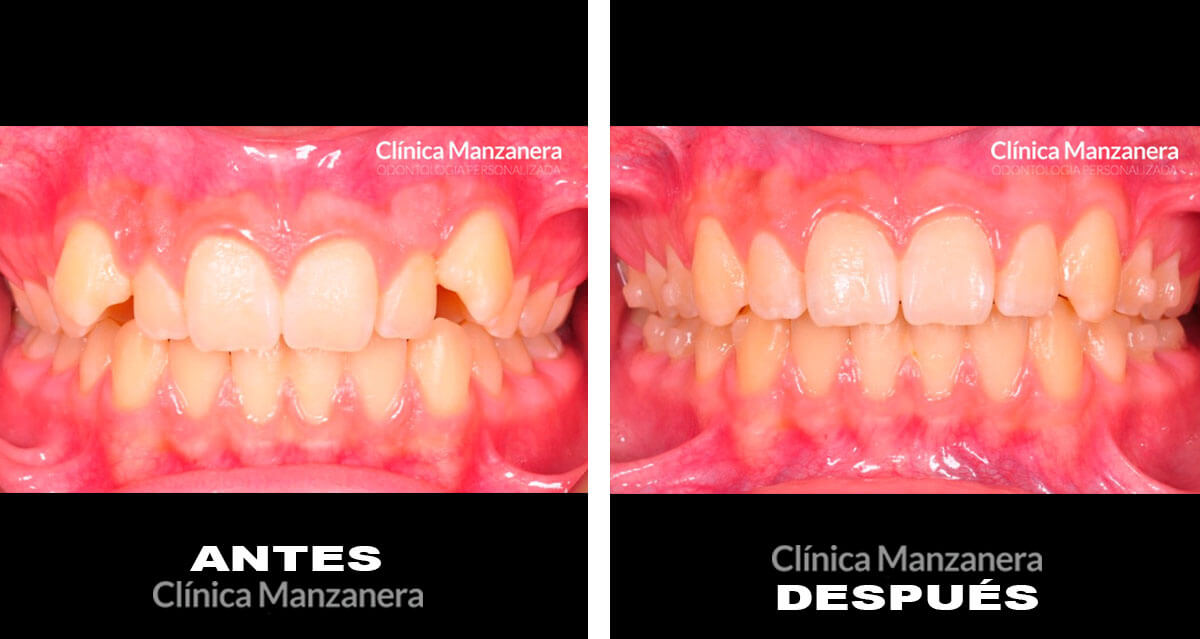 antes y después invisalign teen