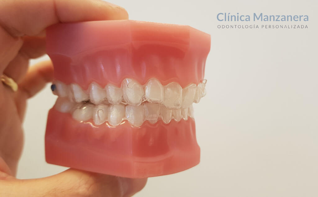 caso resuelto invisalign teen