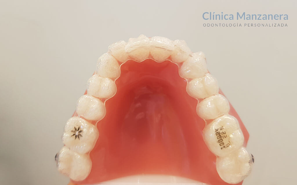 caso invisalign teen valencia