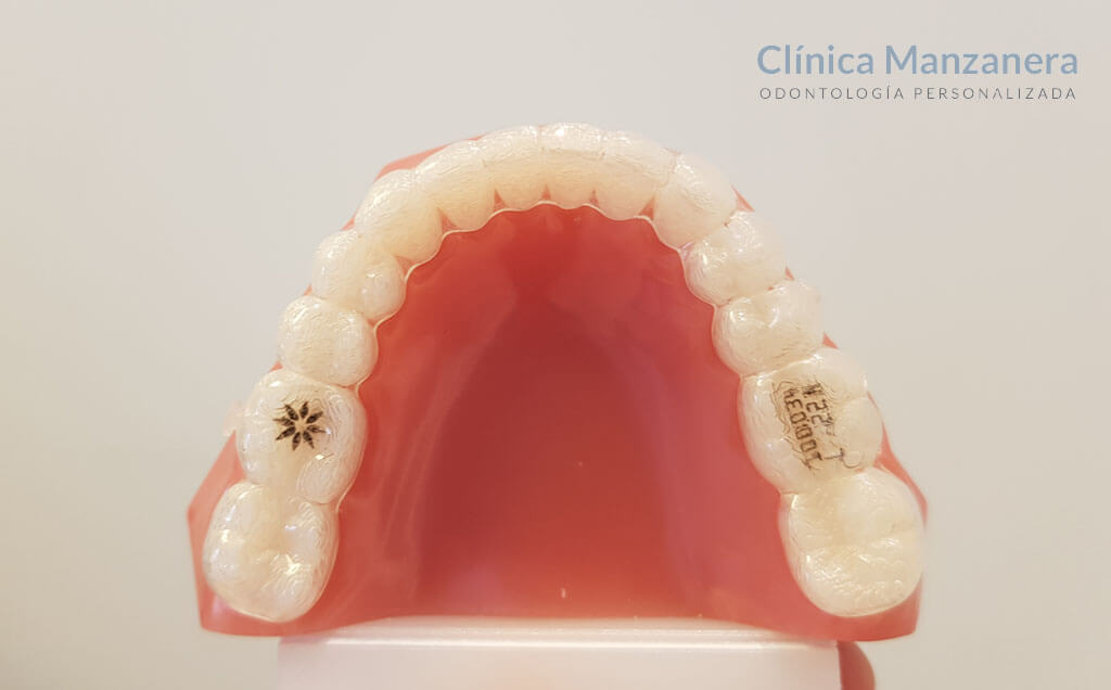 casos resueltos ortodoncia invisalign teen