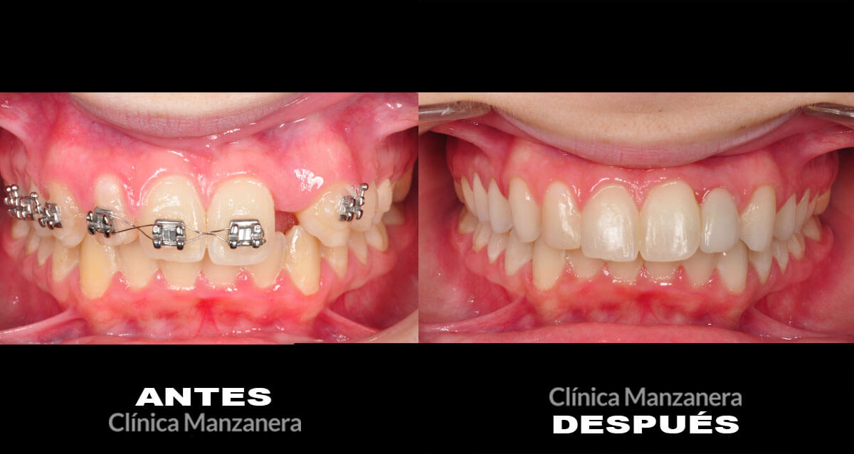 agenesia dental valencia