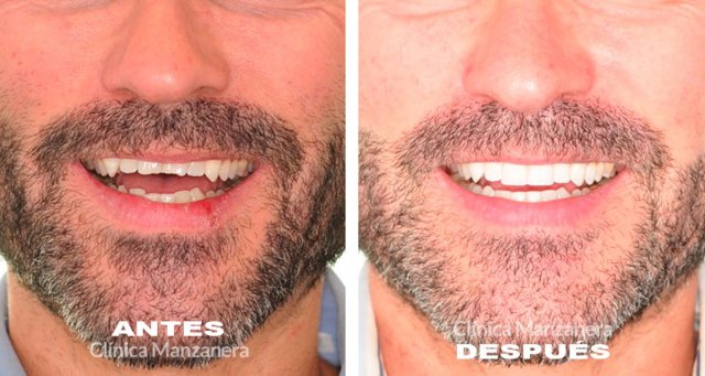 antes y despues invisalign mordida borde a borde