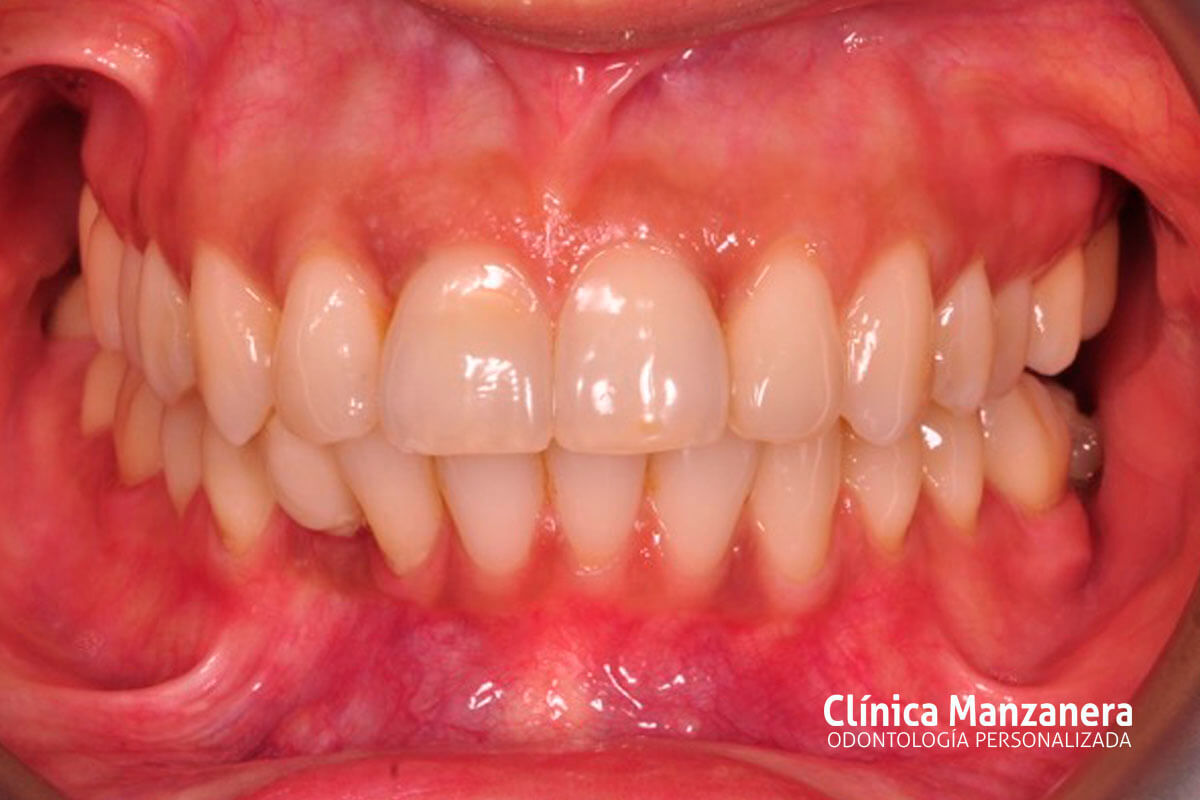 caso clinico ortodoncia invisible antes y despues