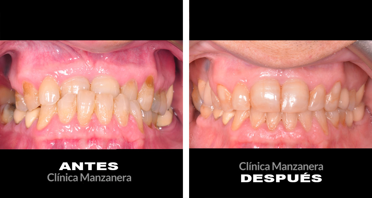 70 anos dientes desgastados, ausencias dentarias antes y despues implantes