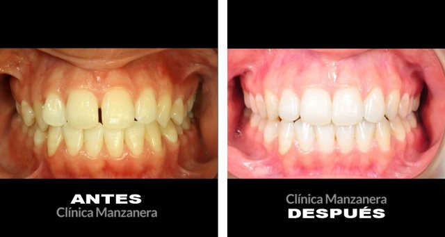 caso antes y despues separacion dientes resuelto con ortodoncia lingual