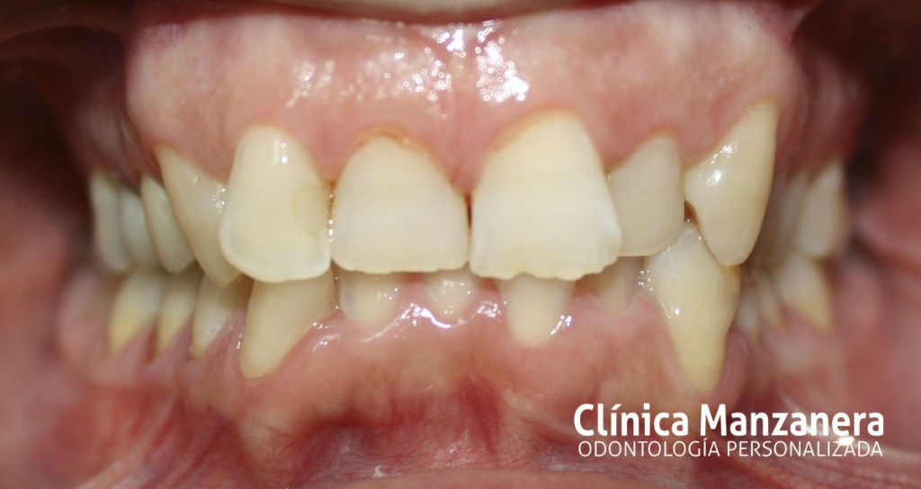 ¿Qué es el Apiñamiento Dental y Porque se Produce? - Clínica Manzanera