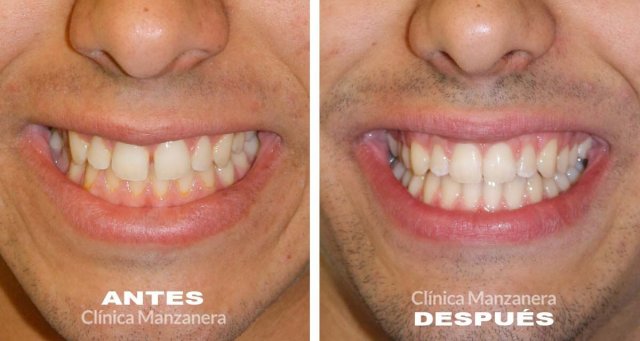 foto antes y después caso diastema o espacio entre los dientes