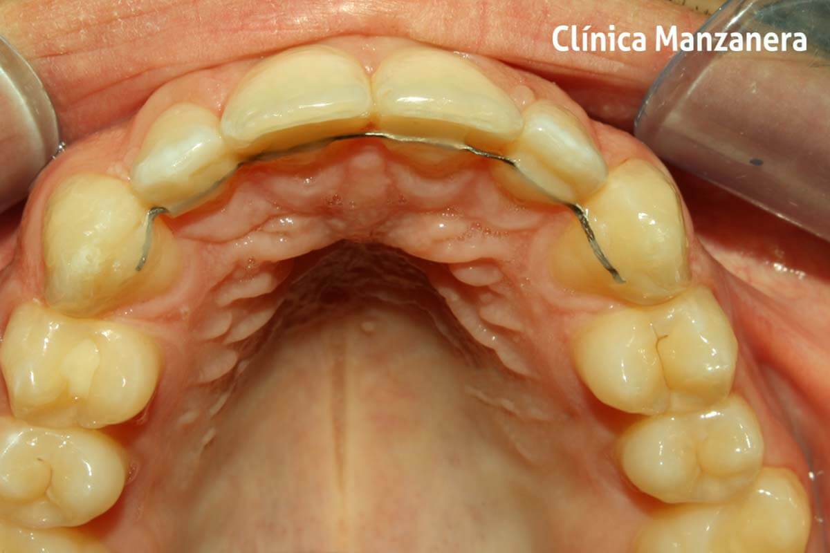 retenedor caso resuelto diastema o separacion dientes