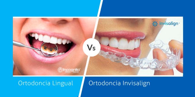 ortodoncia lingual vs invisalign