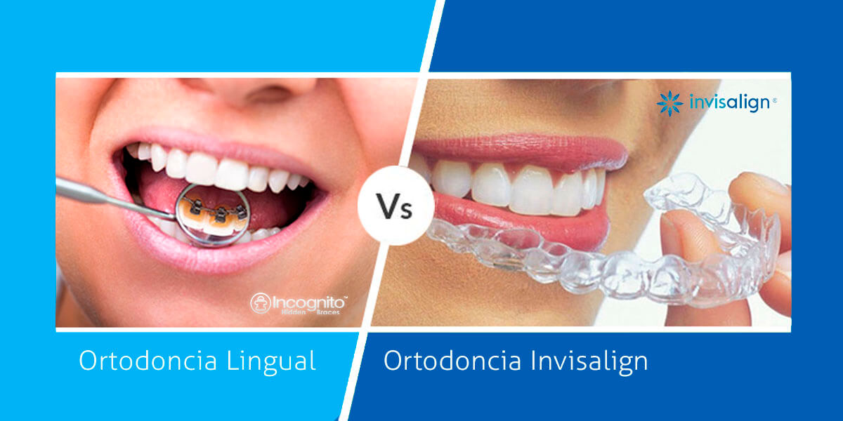 Comparativa Invisalign vs lingual: Casos donde Invisalign No sirve