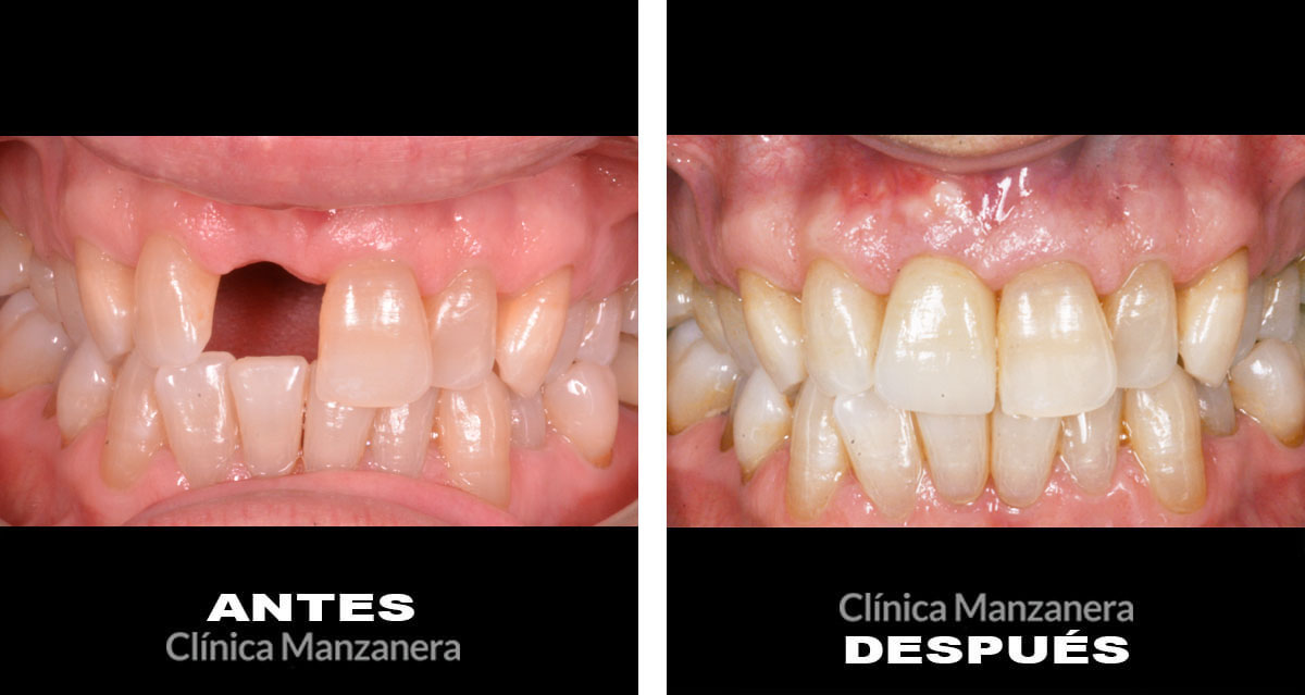 Antes y después perdida dental resuelta con implantes dentales