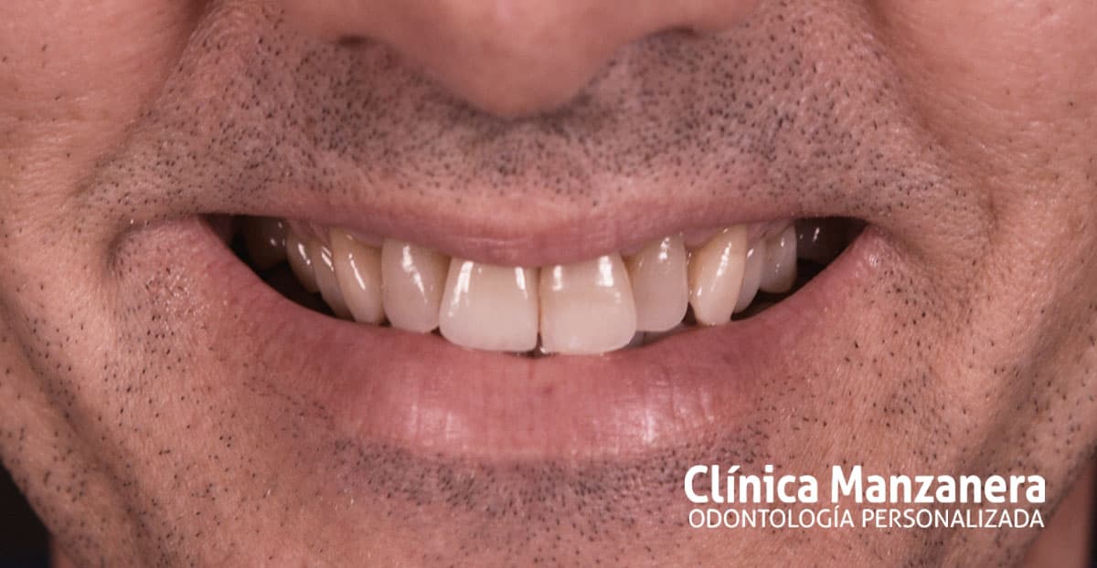 resultado final recuperación dental con implantes dentales