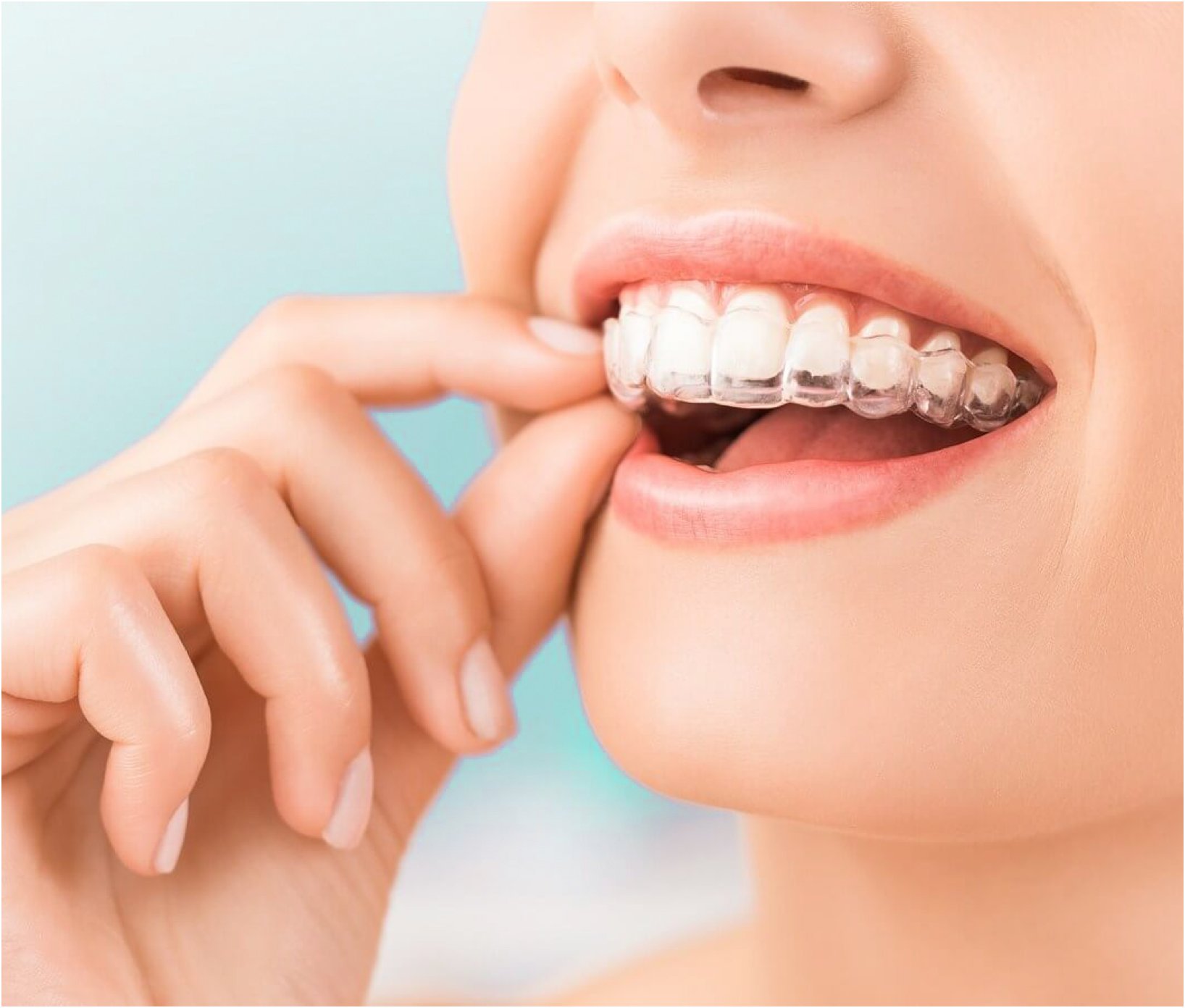 Invisible Braces in Spain Clínica Manzanera