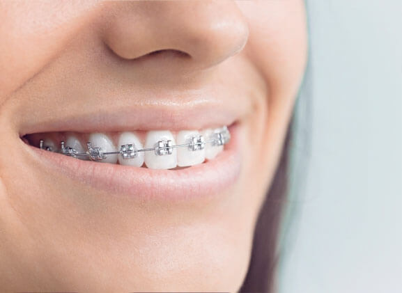 mujer brackets metalicos