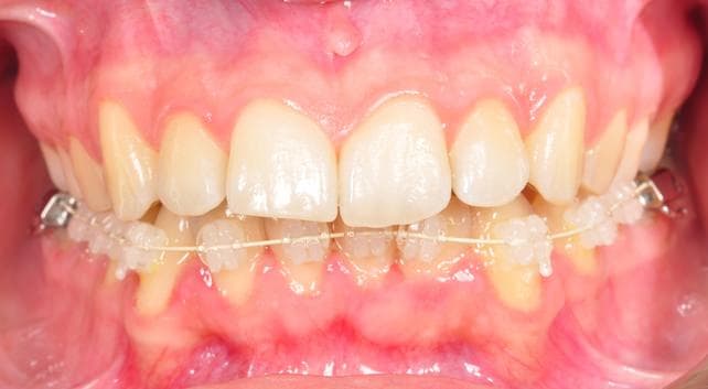 ortodoncia lingual combinada