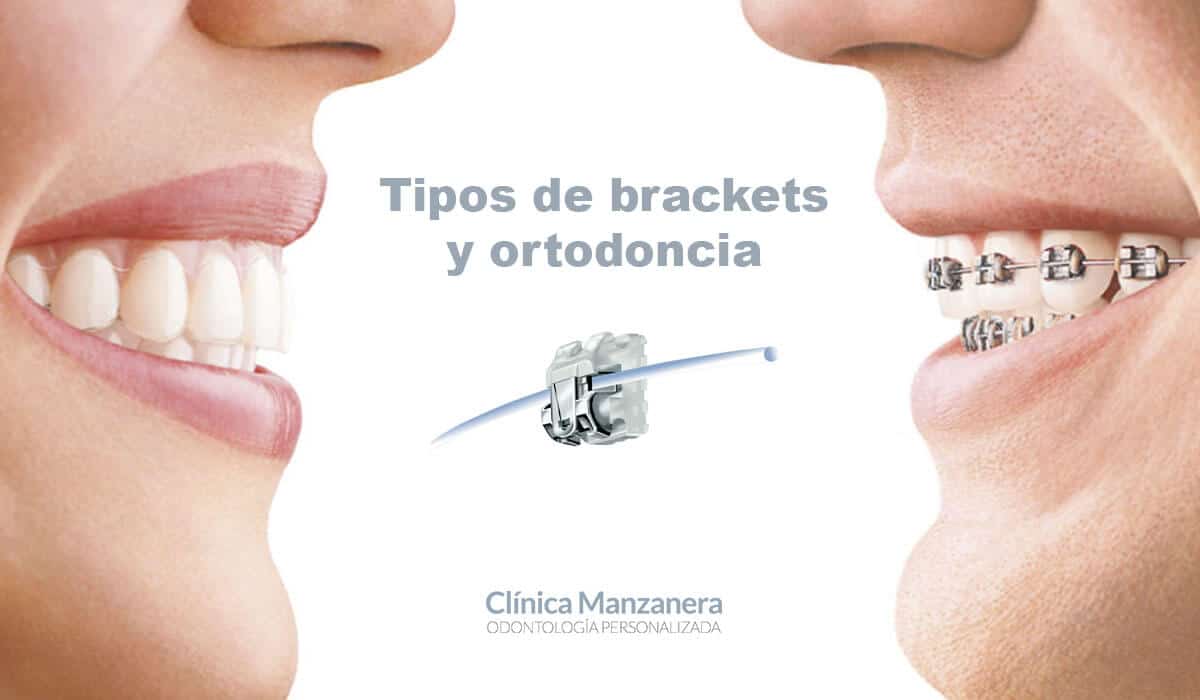 tipos de ortodoncia y brackets