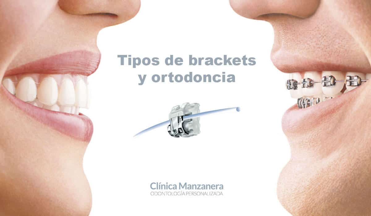 Nuevos Dientes Ortodoncia Aparato Aparato Aparato Aparatos