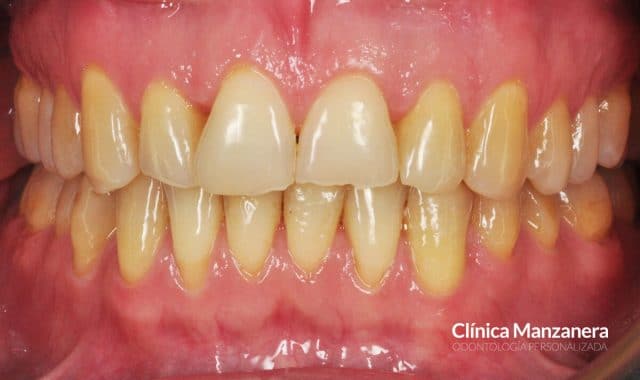 Caso Contorneado Dental estético en bordes incisales - Clínica Manzanera
