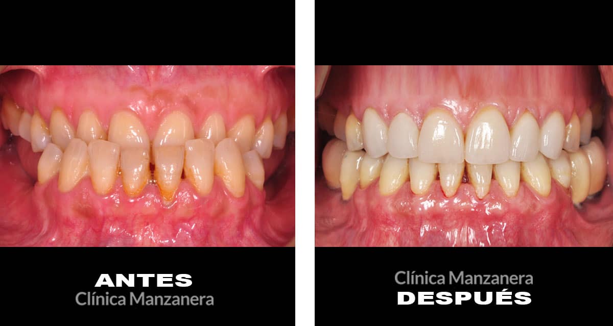 caso antes y después mordida cruzada anterior completa