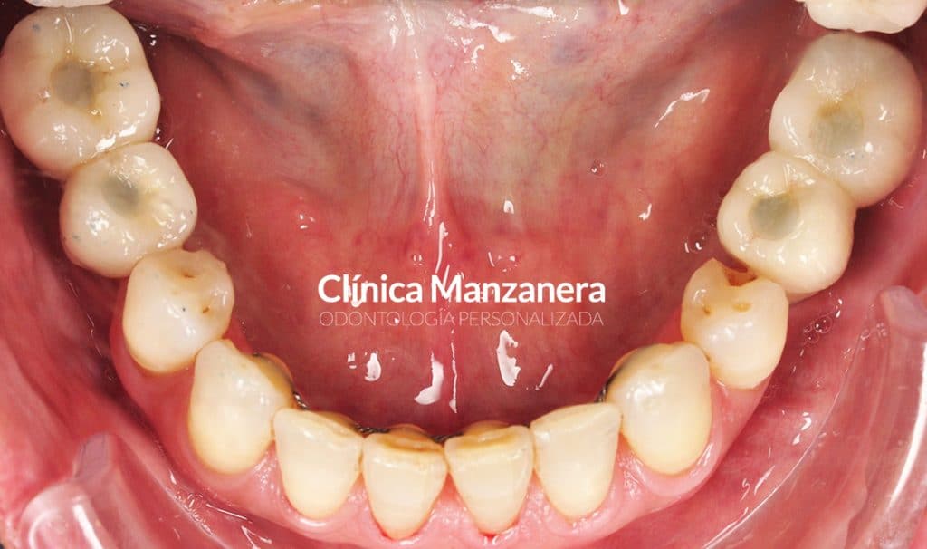 después mordida cruzada anterior oclusal inferior