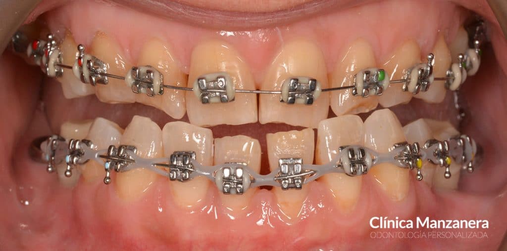 ortodoncia convencional mordida cruzada anterior