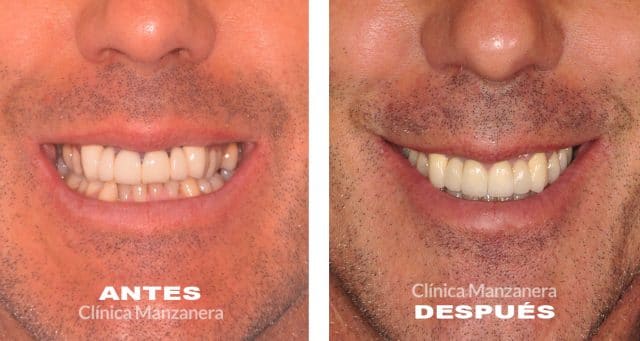 caso antes y después regeneración sonrisa