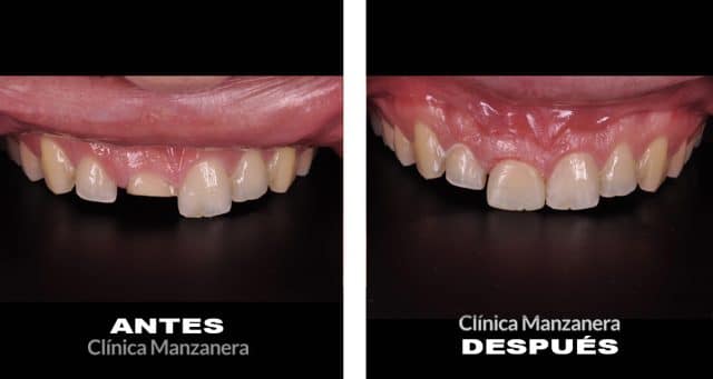 reconstrucción temporal con composite estético antes y después