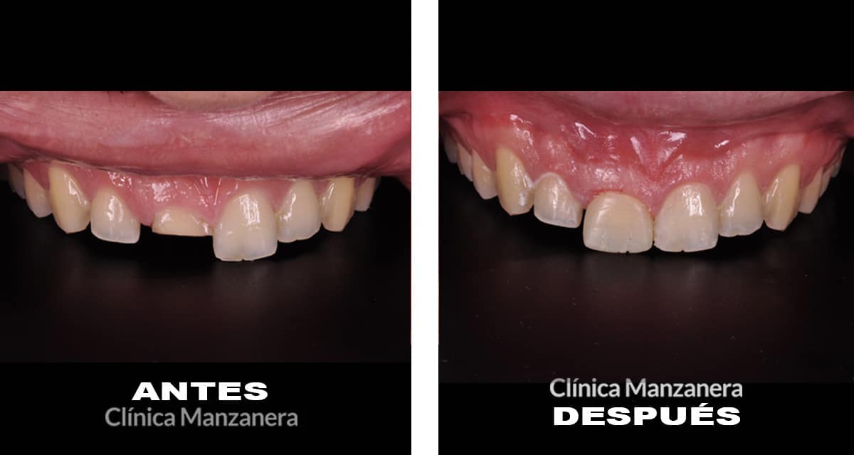 reconstrucción temporal con composite estético antes y después