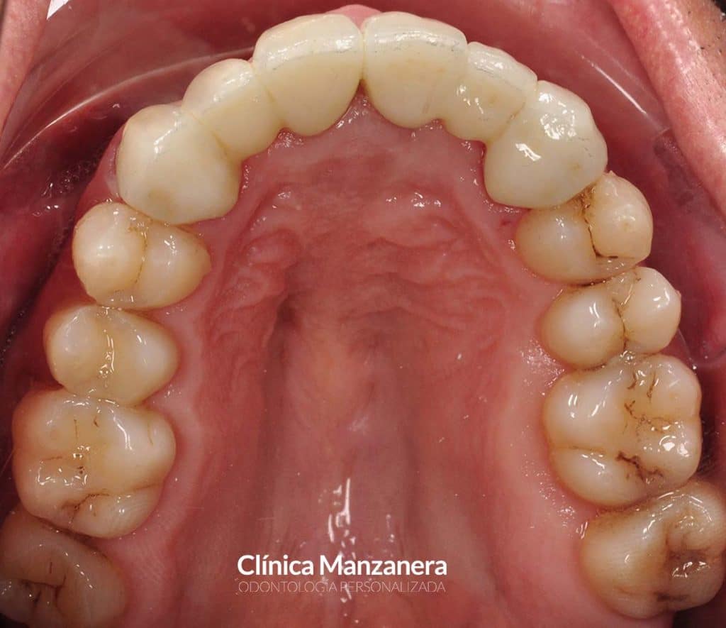 vista oclusal superior puente dental ceramico