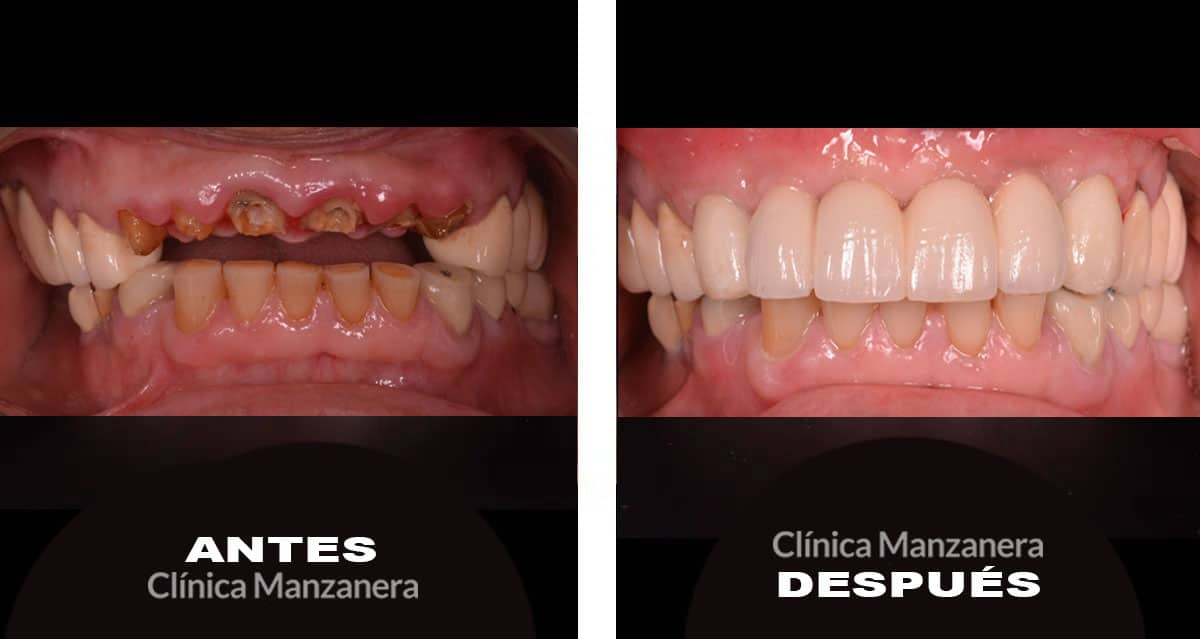 antes y después puentes sobre implantes