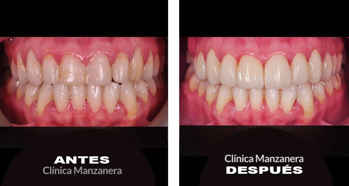 caso antes y después cambio carillas dentales