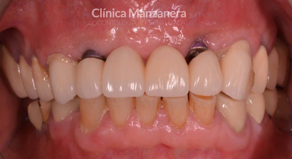 puente dental desajustado y envejecido mal estado