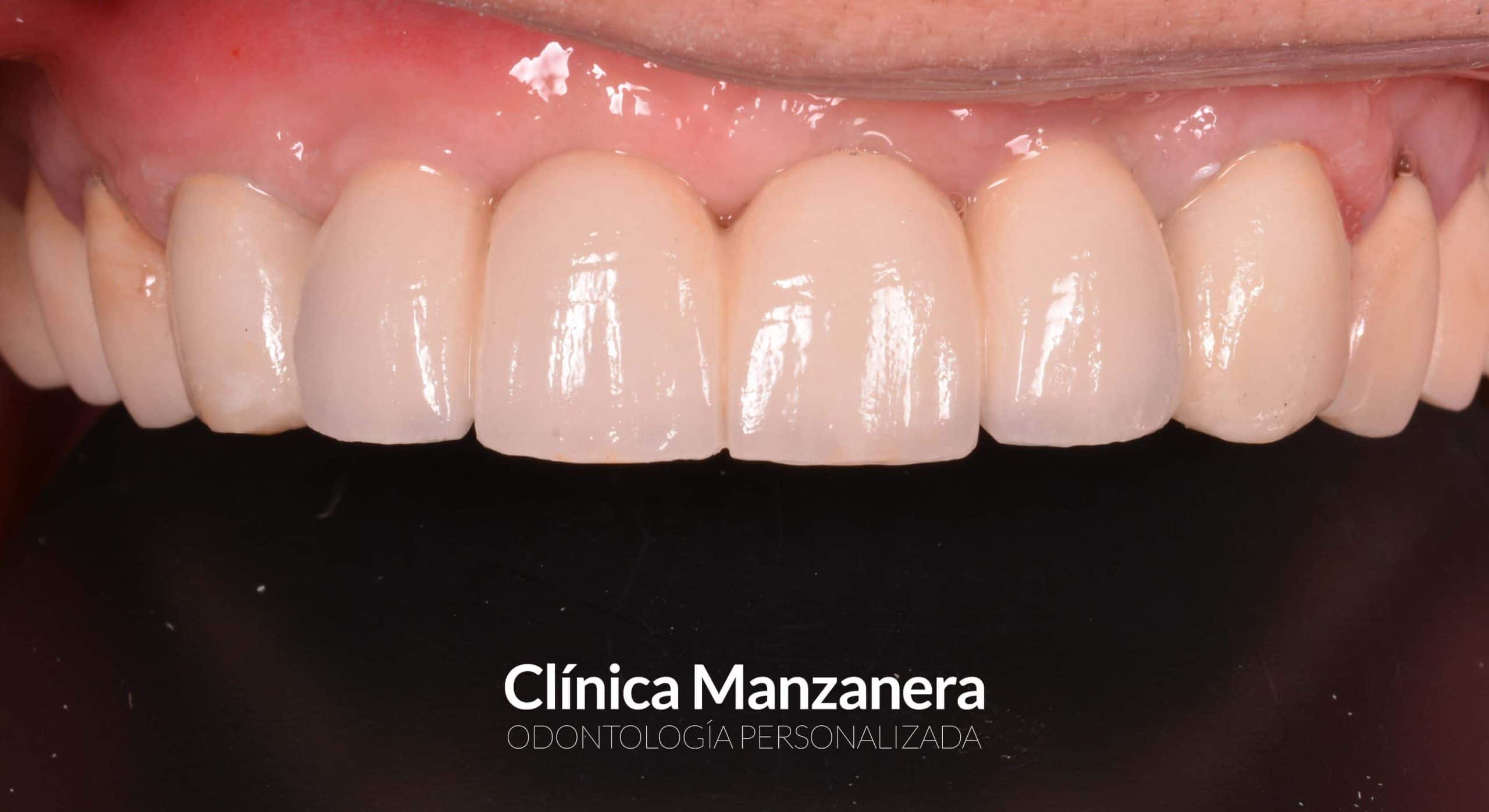 puentes dentales sobre implantes