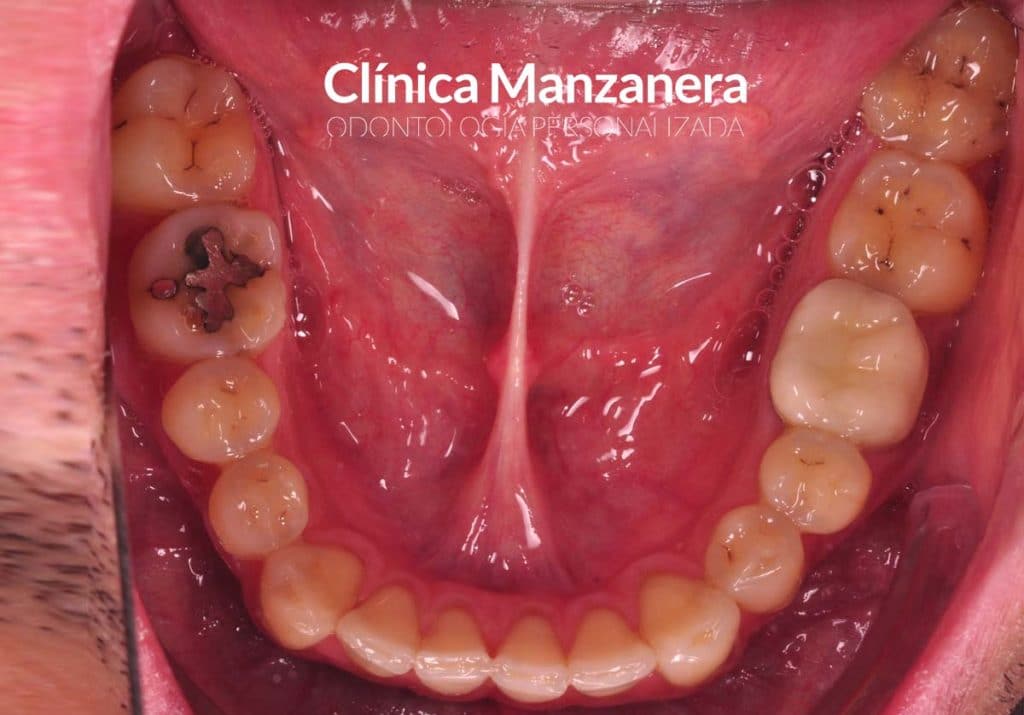 vista oclusal inferior antes2